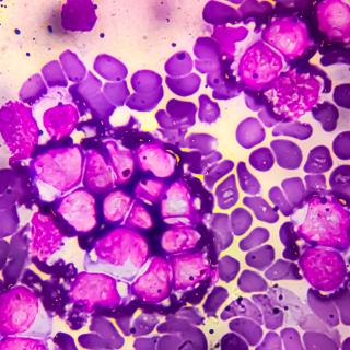 Microscopy image of B-cell acute lymphoblastic leukemia