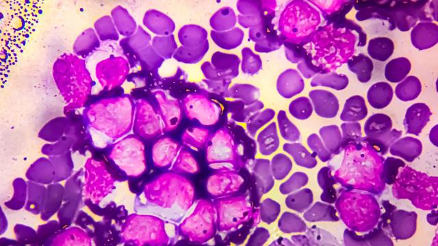 Microscopy image of B-cell acute lymphoblastic leukemia